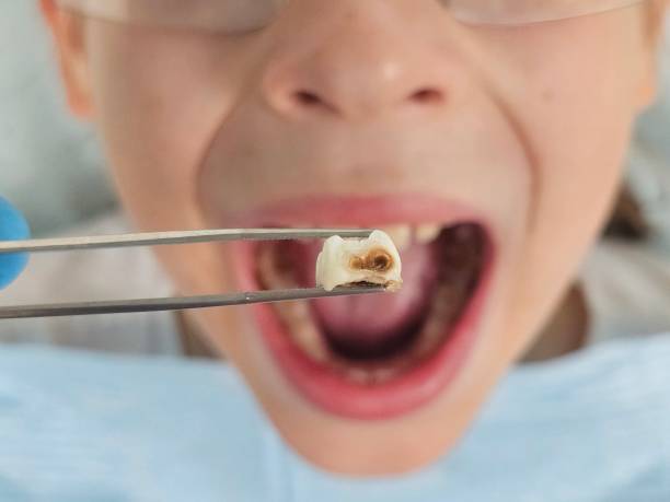 Best Emergency Dental Care for Broken or Chipped Teeth in Bean Station, TN